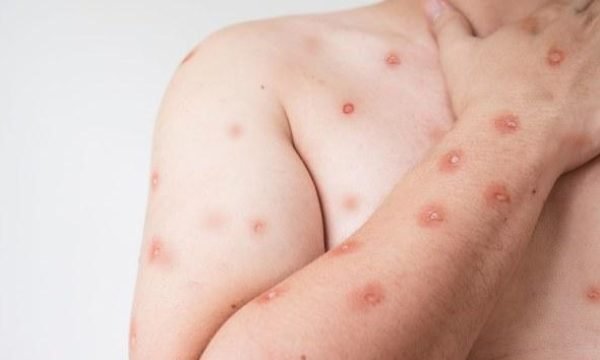 SES alerta para monitoramento de casos de Mpox em MT após avanço de variante em Rondônia