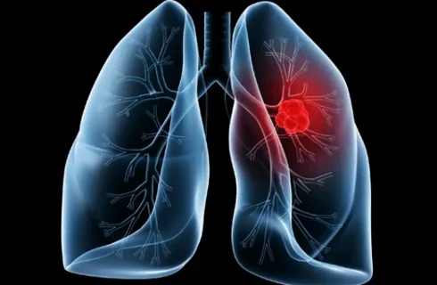 Saiba o que é adenocarcinoma pulmonar, câncer que atinge o papa